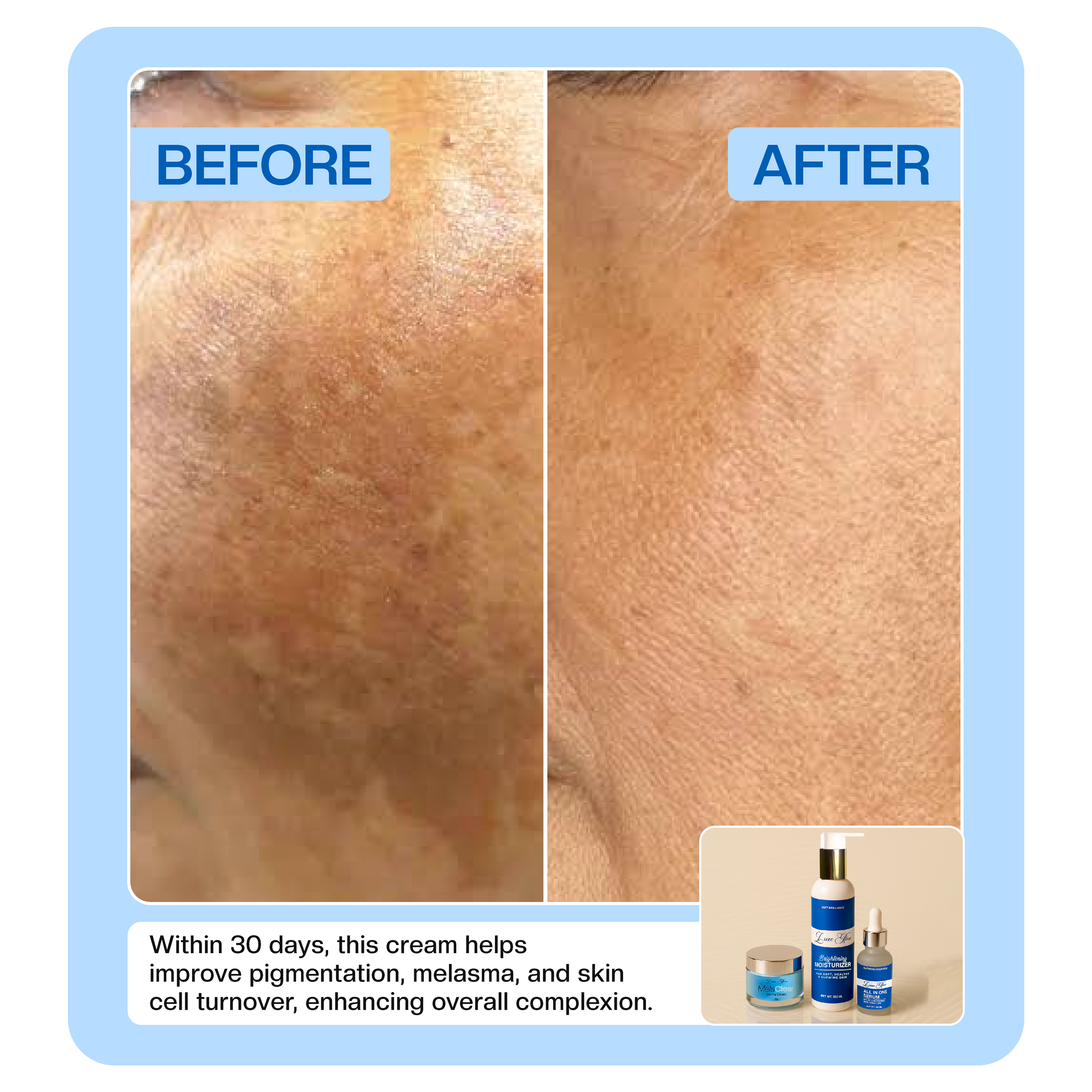 MelaClear Derma Cream (Buy 1 Get 1 Free 🎁)